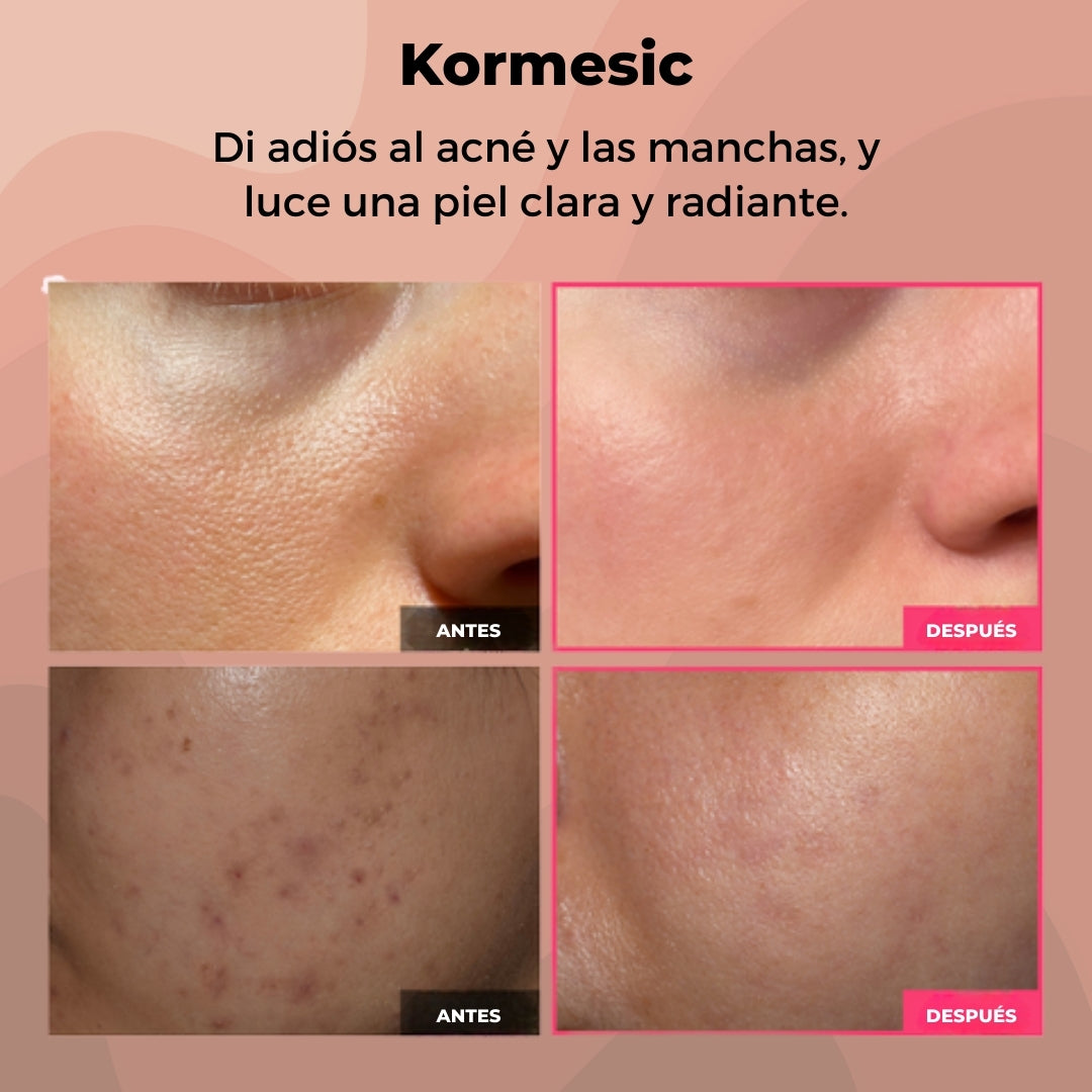 Dile Adiós Al Acné Y Las Manchas De Una Vez Con Kormesic™